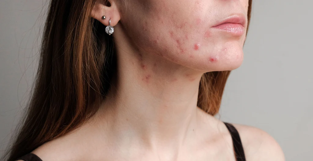 Read more about the article Cystic Acne: Dos and Don’ts for Managing Your Skin