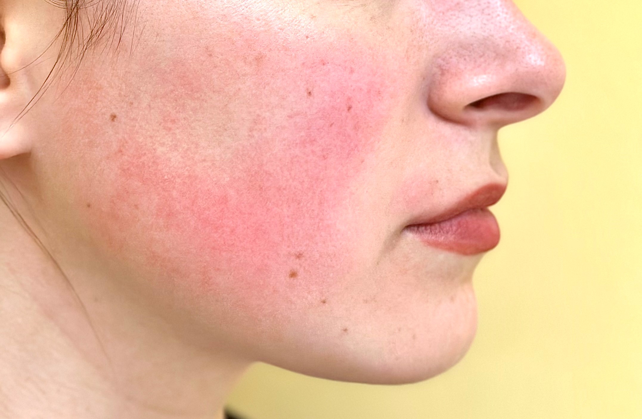 Read more about the article Warning Signs You Might Have Rosacea